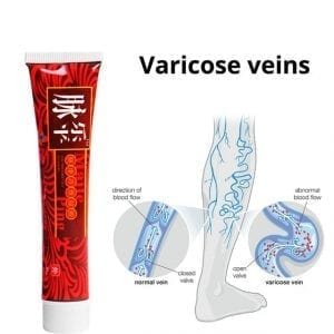 Varicose Veins Treatment Cream Effective cure Vasculitis Phlebitis Spider Veins Pain Varicosity Angiitis ointment Health Care