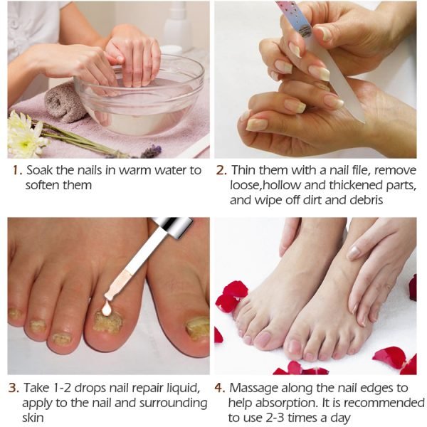 VIBRANTGLAMOUR Fungal Nail Treatment Feet Care Serum Nail Foot Nail Fungus Removal Gel Anti Infection Paronychia 4