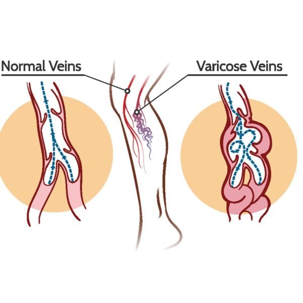 KONGDY Varicose Veins Treatment Cream Varicosity Angiitis Remedy Ointment Relief Veins Pain Phlebitis legs Varicose Veins 2