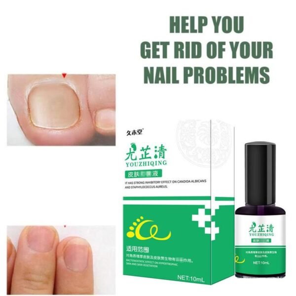Nail Fungal Cure Nails Fungus Wart Removal Liquid Nutritious Anti Paronychia Onychomycosis Foot Repair Fungal Nail 3