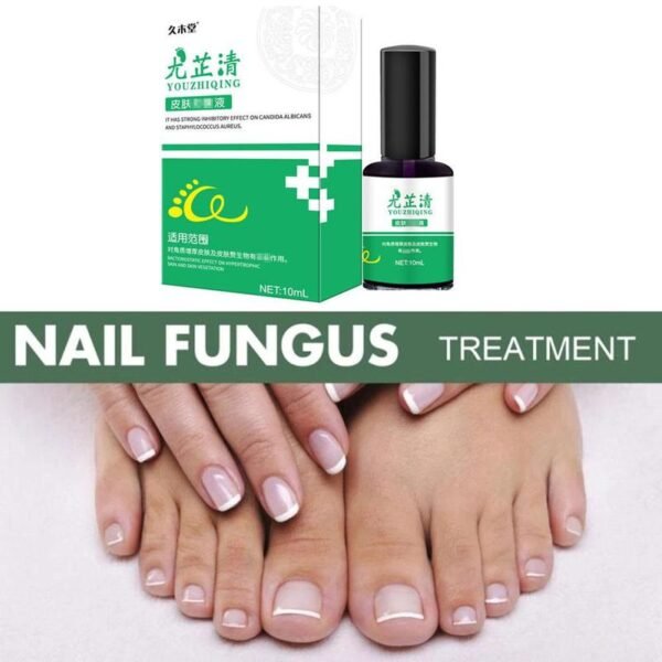 Nail Fungal Cure Nails Fungus Wart Removal Liquid Nutritious Anti Paronychia Onychomycosis Foot Repair Fungal Nail 4
