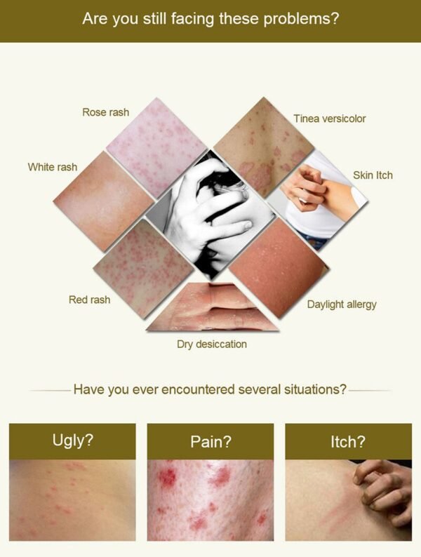 QICAOGANGMU Skin Psoriasis Cream Dermatitis Eczematoid Eczema Ointment Treatment Psoriasis Relieve Various Skin Problem TSLM1 4