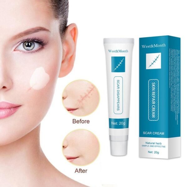 20g Acne Scar Removal Cream Repair Burn Surgical Scars Stretch Marks Promote Cell Regeneration Repair Treatment 5